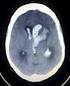 Ictus Acuto: Fase di Ospedalizzazione (Diagnosi) Ictus Cerebrale: Linee Guida Italiane di Prevenzione e Trattamento