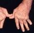 La diagnosi precoce dell Artrite Reumatoide