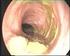 L ENDOSCOPIA NELLE IBD