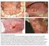 Diagnosi istopatologica delle lesioni precancerose del colon-retto: proposta per uno SLIDE SEMINAR multicentrico