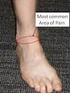 Anterior ankle impingement syndrome