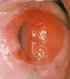 Dolore ai rapporti e vestibolite vulvare Prima parte Dalle cause alla diagnosi: l'iperattivazione del mastocita