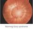 La polarimetria laser confocale nella neuropatia ottica glaucomatosa: influenza del cristallino
