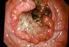 Neoplasie del Tratto Gastro-Enterico ( Colon-Retto, Stomaco, Pancreas e Vie biliari)
