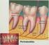 parodontologia periodontal