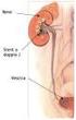 INTERVENTO DI URETERORENOSCOPIA CON LITOTRISSIA ENDOSCOPICA AD ENERGIA BALISTICA (LITHOCLAST) PER CALCOLOSI URETERALE