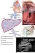 IPERTENSIONE PORTALE ed ASCITE