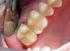 Gli intarsi adesivi per il restauro dei denti posteriori trattati endodonticamente