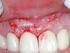 Il ruolo dell Endodonzia nel trattamento dei denti permanenti lussati