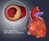 La placca aterosclerotica nelle sindromi coronariche