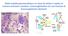 Nella malattia plasmacellulare un clone di cellule si replica in maniera anomala e produce immunoglobulina e/o una frazione di immunoglobulina