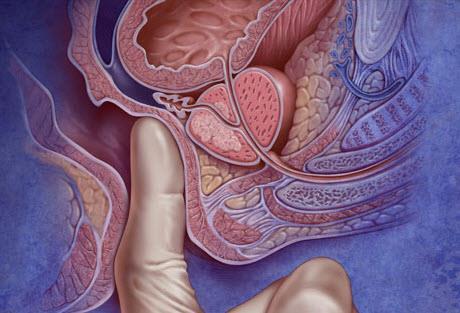 La prevenzione del carcinoma prostatico: l esplorazione rettale I sintomi del carcinoma della prostata ( dolori ossei, difficoltà ad urinare) non sono specifici di questa malattia e compaiono in ogni