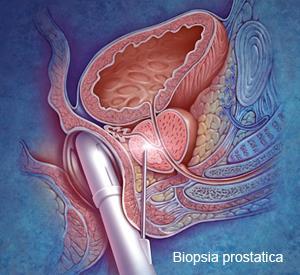 Diagnosi e stadiazione del carcinoma prostatico In caso di sospetto clinico, l'unico esame in grado di consentire la diagnosi del carcinoma prostatico è la biopsia, ossia l'asportazione di piccoli