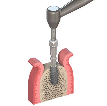 5.4 Inserimento dell'impianto Gli impianti Straumann BLX possono essere inseriti usando il contrangolo o manualmente usando il cricchetto.