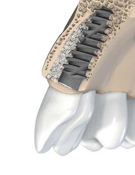 5.5 Gestione dello spazio Nessun impianto corrisponde alla situazione anatomica individuale dopo l'estrazione del dente, pertanto le procedure di trattamento immediato possono richiedere un ulteriore