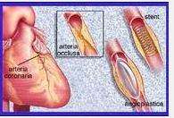 90 min da infarto STEMI.