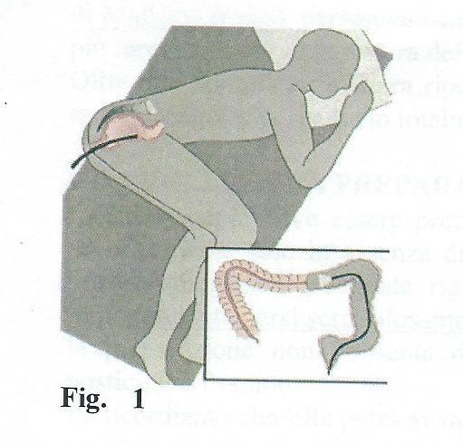 COLONSCOPIA Che cosa è e come si svolge La colonscopia è un esame diagnostico che consente al medico di esplorare l interno del colon (intestino crasso) e l ultimo tratto dell intestino tenue (ileo