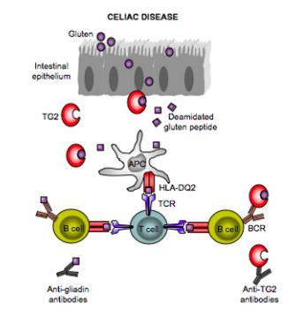 La malattia celiaca La celiachia è una malattia sistemica (non solo enteropatia) immunomediata, scatenata dal glutine in soggetti geneticamente