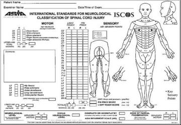 SCALA DI VALUTAZIONE ASIA Impairment Scale (AIS) AIS=A: lesione completa sia motoria che sensitiva; AIS=B: lesione incompleta dove la sensibilità è preservata, mentre vi è un assenza di funzioni