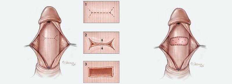 Grafting procedure (procedure di allungamento) Indicato per curvature complesse e peni di piccole dimensioni (raro nei casi congeniti) Rispetto alle precedenti sono più