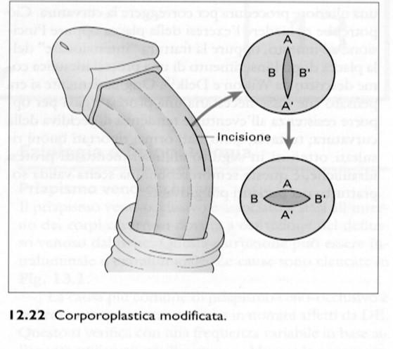 Corporoplastica sec Yachia: Incisione longitudinale e sutura trasversa della tunica albuginea Indicata per curvature minori (se applicata per