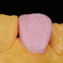 LINEE GUIDA INDIVIDUALI Stratificazione Costruzione anatomica completa del dente con dentina e taglio della dentina nel terzo incisale. Fig. 11: completamento della forma anatomica Fig.