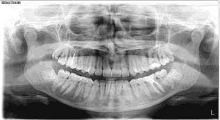 TERAPIA METASTASI OSSEE Gennaio 2018 Rx Ortopanoramica: : Non immagini radiotrasparenti a carico delle