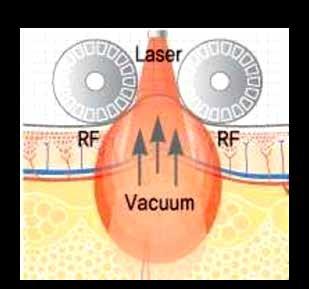 Radiofrequenza Multipolare Vacuum Laser LLLT La combinazione di RADIOFREQUENZA MULTIPOLARE e LASER LLLT crea un intenso calore termico nei tessuti connettivi, compreso il setto fibroso.