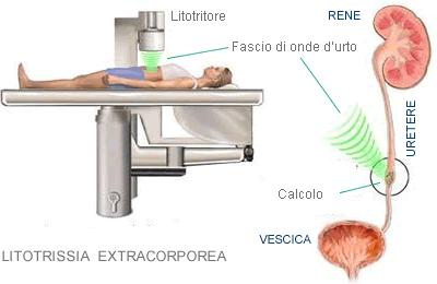 Dipartimento Chirurgia Generale e Specialistiche Day Surgery GENTILE SIGNORA, GENTILE SIGNORE questo opuscolo è stato pensato per lei che si dovrà sottoporre al cosiddetto bombardamento dei calcoli.