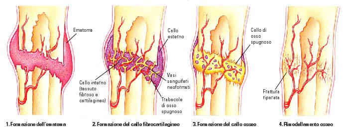 Processo di riparazione dell osso Determinato dalla vascolarizzazione della