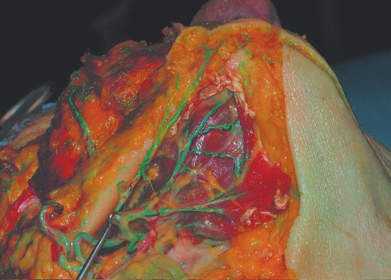 vena faciale; 6) arteria faciale B C Figura. Dissezione su cadavere. A-C.