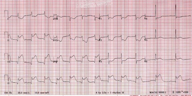 transmurale del muscolo cardiaco che da quel vaso dipende