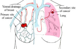 Metastasi per via ematica sarcomi Utilizza principalmente le vene Sangue venoso refluo con: Vena porta va al fegato Vena cava al polmone Cellule cancerose circolanti si fermano