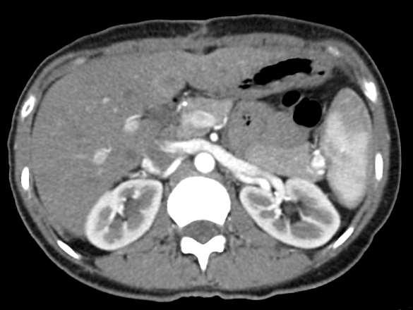 Aspetto maggiormente sfumato delle multiple lesioni