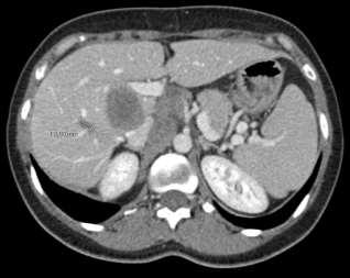 Dopo 5 cicli di Nivolumab Lesione