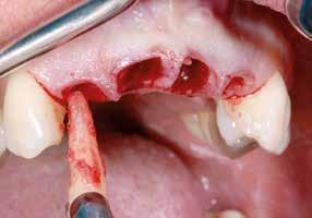 casi della premaxilla, con completa perdita della corticale dalla malattia parodontale. Il mantenimento poi dei vestibolare e palatale lungo le radici degli incisivi superiori (Fig. 3).