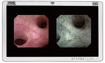 Fonte immagini endoscopiche: Professor Knoll, Clinica urologica di Sindelfingen, Klinikverbund-Südwest, Germania