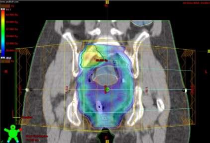 utilizzavano l IMRT nella loro pratica clinica: - di questi il 35% dei casi erano tumori ginecologici