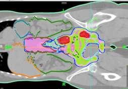 Le pazienti ginecologiche con malattia localmente avanzata, ad esempio, con linfonodi