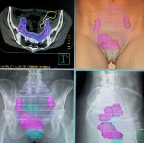 IMRT IGRT - TOMOTERAPIA: Extended fields e dose escalation L IMRT- IGRT -TOMOTERAPIA permette di