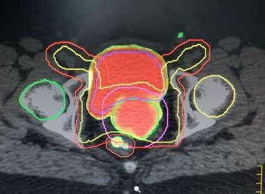 IMRT) sui volumi pelvici Usando l IMRT- IGRT -TOMOTERAPIA, il volume di intestino che riceve 45 Gy -> e