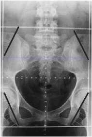 La EBRT nelle neoplasie ginecologiche: vantaggi