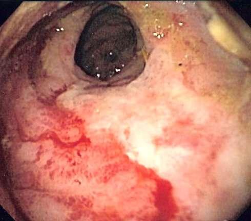 3D-CRT: Tossicità GU e GI 1784 pz con ca cervice radiotrattate Nonostante i vantaggi della 3D, permane ALTO il rischio di tossicità, in relazione agli ESTESI volumi di OAR irradiati.