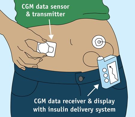 CSII + CGM (continuum glucose monitoring) SAP: sensor augmented insulin pump, microinfusore integrato con sensore per monitoraggio glicemico in tempo reale (RT-CGM) il paziente visualizza i valori