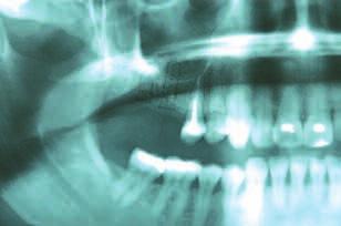 rilascio. A5 Incisione di rilascio mesiale: mesiobuccale, a forma di C, in corrispondenza del dente mesiale adiacente.
