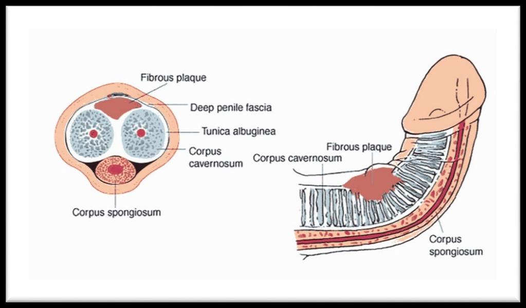 Malattia di Peyronie o Iduratio Penis Plastica (IPP) La malattia prende il nome da Francois Gogot de Peyronie, Chirurgo francese alla Corte di Versailles che la descrisse nel 1743.