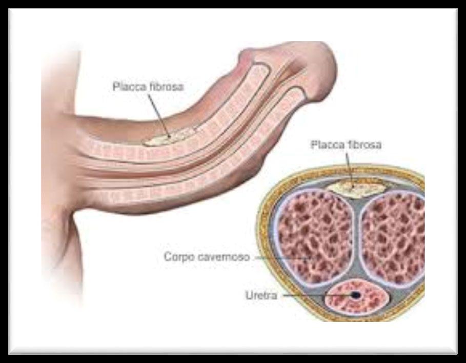 La prima fase è caratterizzata dalla predominanza dei processi infiammatori, con comparsa delle placche fibrose, della loro evoluzione con deformazione e curvatura del pene e solitamente dolore sia