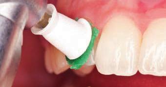 Particolarmente delicata la pasta non provoca abrasioni superflue della dentina o delle superfici dei