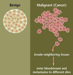 DISTINZIONE TRA NEOPLASIE BENIGNE E MALIGNE I criteri su cui si basa la distinzione tra tumori benigni e maligni possono