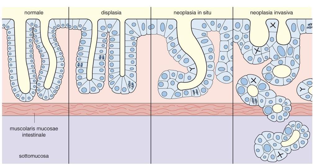 DISPLASIA: proliferazione disordinata si riscontra principalmente negli epiteli Perdita di uniformità dell aspetto delle